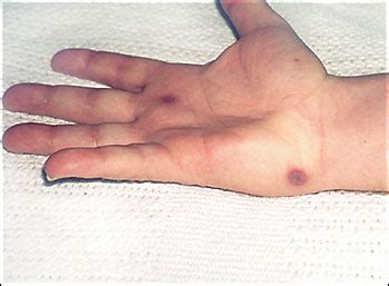 Hemorrhagic Pustules, Tenosynovitis, and Arthritis - Photo Quiz ...