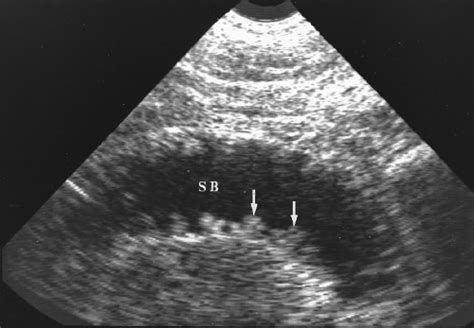 Ultrasound of the Gastrointestinal Tract | Radiology Key