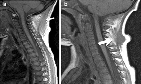 Various patterns of nuchal ligament injury on T1-W MR sequence in ...