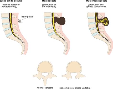 Spina Bifida: A Neural Tube Defect