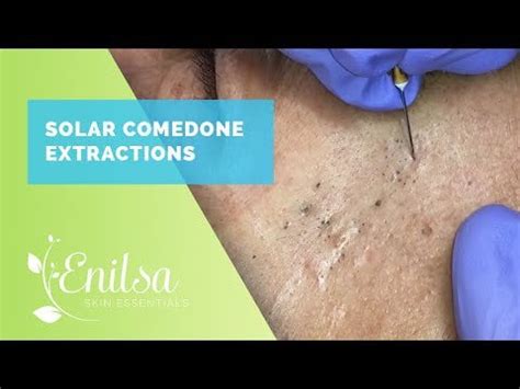 New Enilsa Brown - Solar Comedone Extractions - 22:06 : r/PoppingPimples