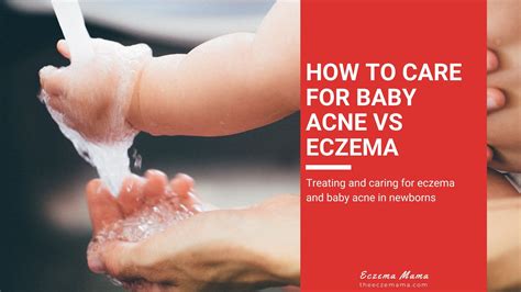 How to Care for Baby Acne vs Eczema - Eczema Mama