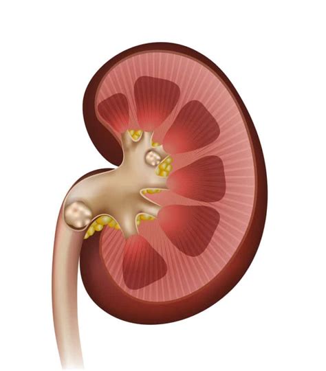 Treatment Options for a 9 mm Renal Stone: New York City Kidney Stone Specialists - NYC Kidney ...