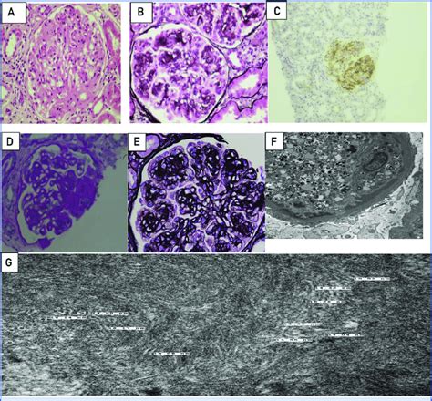 Pathology of membranoproliferative glomerulonephritis with monoclonal ...