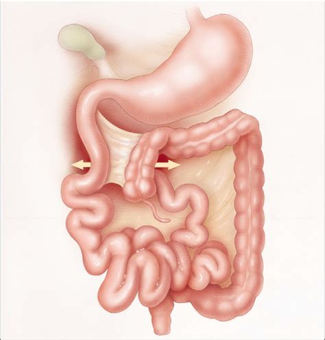 2.1 The Ladd's Procedure for Correction of Intestinal Malrotation With ...