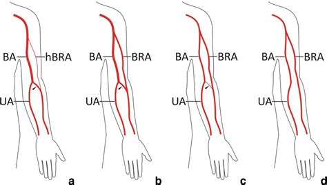 Anatomical variations of the cubital anastomosis between the... | Download Scientific Diagram