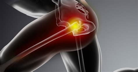 Hip Impingement Diagnosis And Treatment | The Movement Centre