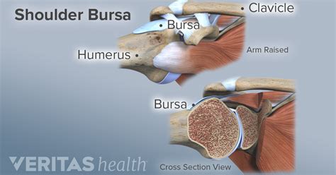 What Is Bursitis Shoulder