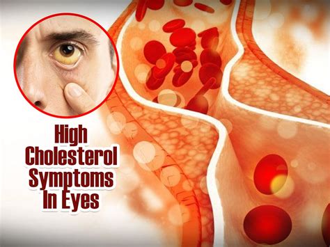 5 High Cholesterol Symptoms In Eyes You Should Know | TheHealthSite.com