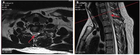 Spinal Cord Injury Mri