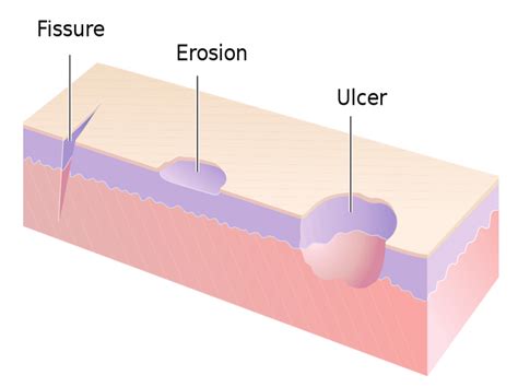 Ulcer Skin