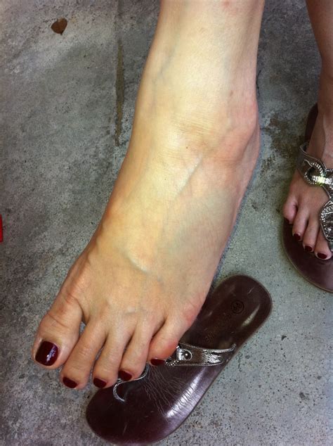 Health for everyone: Bruised veins and arteries on foot