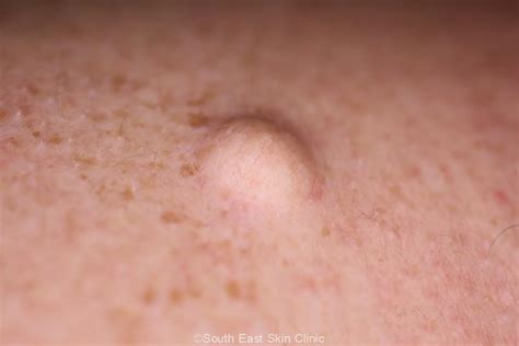 Sebaceous Cyst - South East Skin Clinic