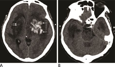 Cerebellar Lesions of Uremic Encephalopathy on MRI in Hemodialyzed Diabetic Patient: A Case Report