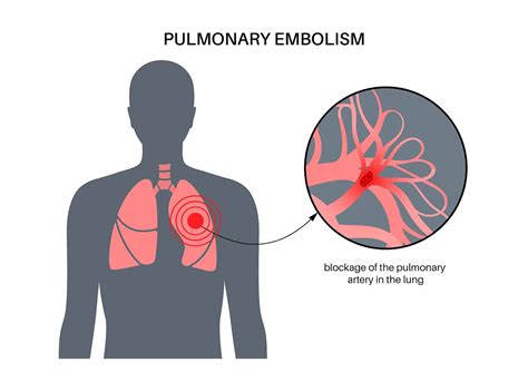3 Symptoms of Pulmonary Embolism - St. Michael's Elite Hospital