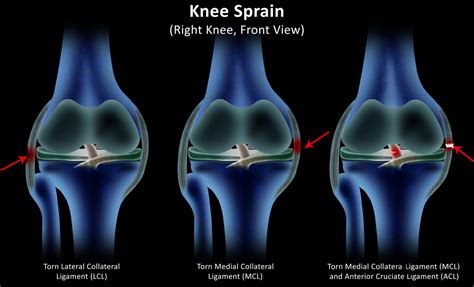 Knee Buckling: What Can Cause Knees To Buckle?