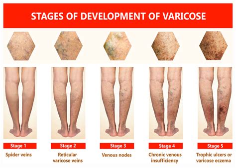 What Is Venous Ulcer Disease? A Doctor's Guide | Vein & Vascular Institute