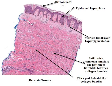 Dermpath Made Simple - Neoplastic: Dermatofibroma