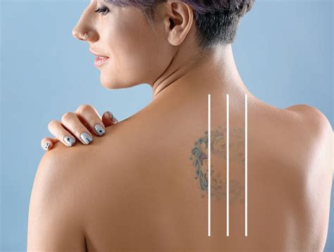 Tattoo Removal, Laser | Chicago| PicoSure | Derick Dermatology