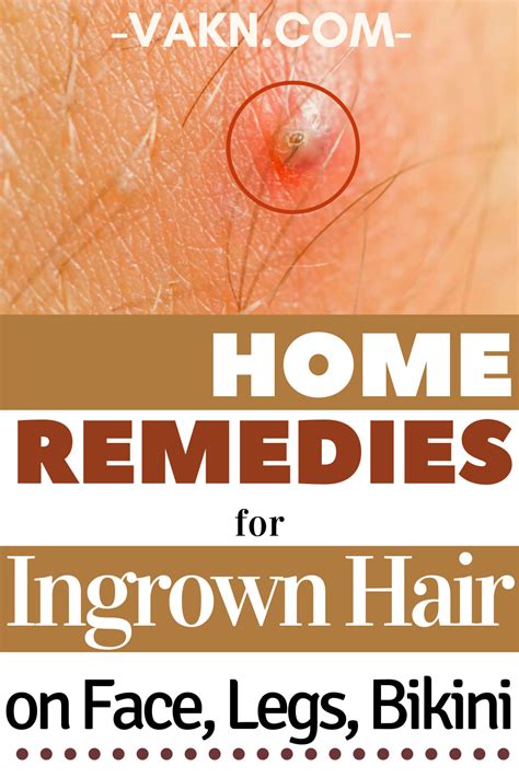 Home Remedies For Ingrown Hair On Face, Legs, Bikini | Ingrown hair remedies, Ingrown hair ...