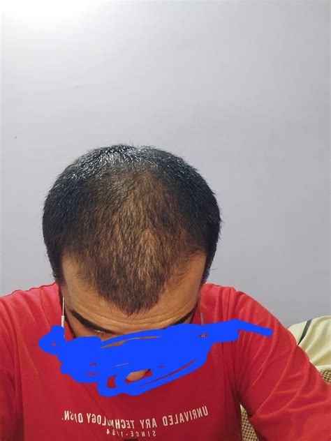 what norwood am i ? what type of haircut should i choose with these kinda hairs : r/malehairadvice