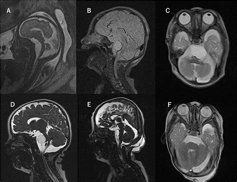 Figure 1 from A neonatal purely prepontine arachnoid cyst: a case report and review of the ...