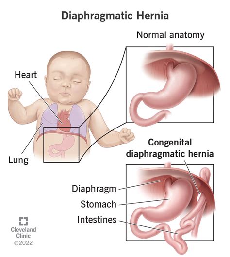 Congenital Diaphragmatic Hernia: Symptoms, Types & What It Is