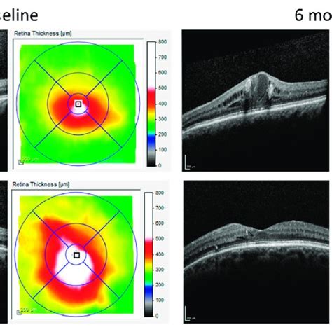 OCT images of DME patients obtained with Heidelberg Spectralis at... | Download Scientific Diagram