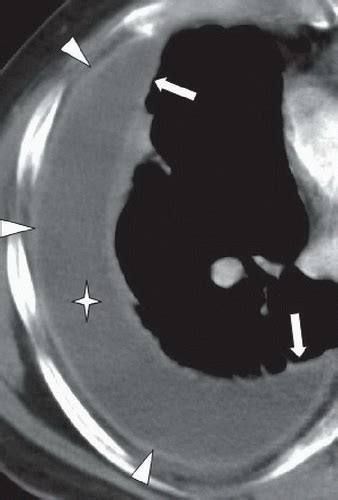 Empyema | Radiology Key