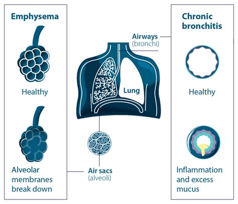 Know Your Disease: Chronic Obstructive Pulmonary Disease (COPD ...