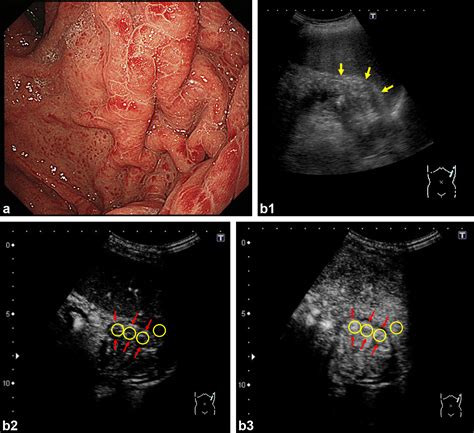 Non-Invasive Diagnosis of Portal Hypertensive Gastropathy: Quantitative Analysis of Microbubble ...