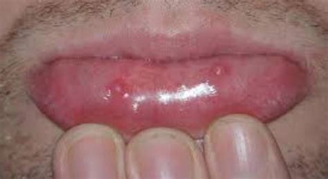 How to Get Rid Of Mucous Cyst on Lip, Roof of Mouth, Retention Cyst ...