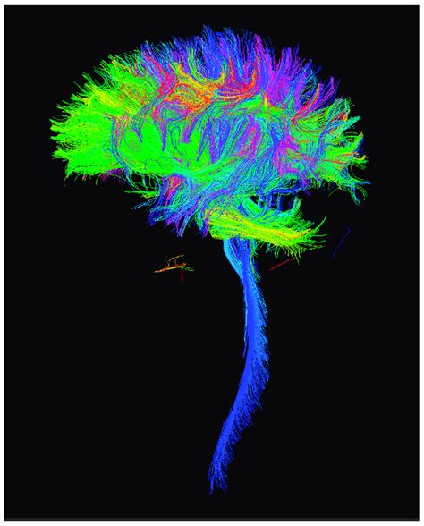 Sample case of whole brain tractography from the diffusion MRI data ...