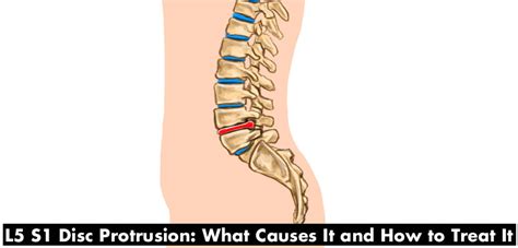 L5 S1 Disc Protrusion—Causes and Treatment of Back Pain Caused by a ...