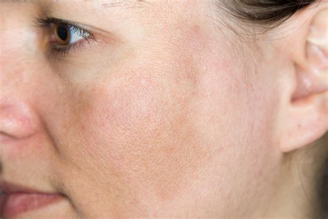 Sun-Damaged Skin: Causes And Effect - Arsenault Dermatology