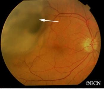 Choroidal Melanoma - New York Eye Cancer Center