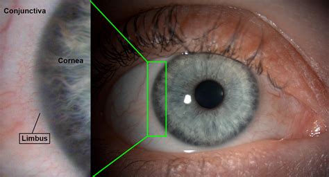 Cornea - Gene Vision