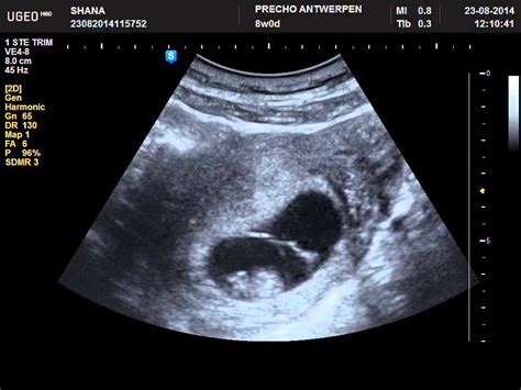 8 Weeks Pregnant 2D Ultrasound: Heartbeat - YouTube