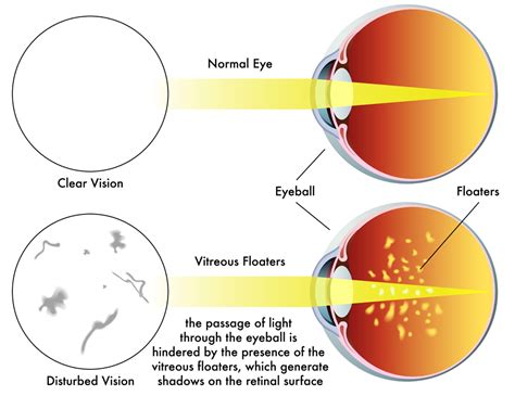 Floaters & Flashes - Exeter Eye