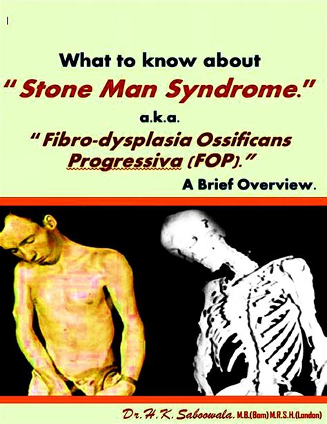 What to know about “Stone Man Syndrome.” a.k.a. “Fibrodysplasia Ossificans Progressiva (FOP).” A ...