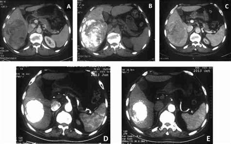 Dynamic changes of lipiodol in the tumor lesion. (A) Baseline ...