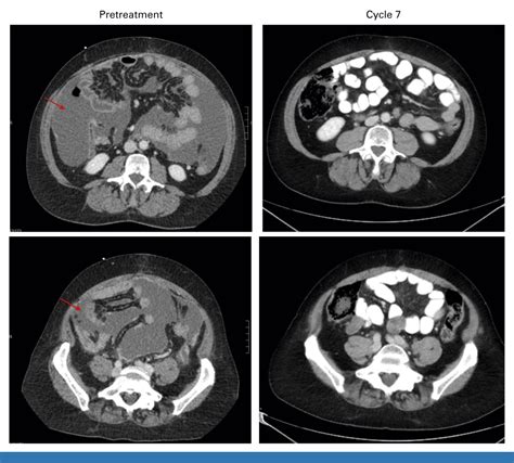 Treatment Approaches for Platinum-Resistant Ovarian Cancer | Journal of ...