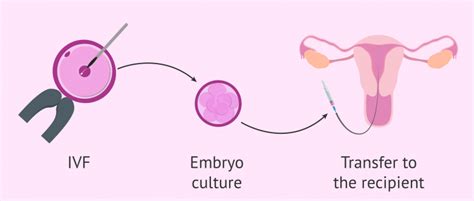 IVF treatment with donor eggs