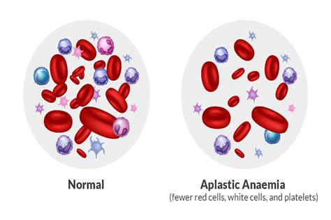 Aplastic Anemia: Causes, Symptoms & Treatment Options