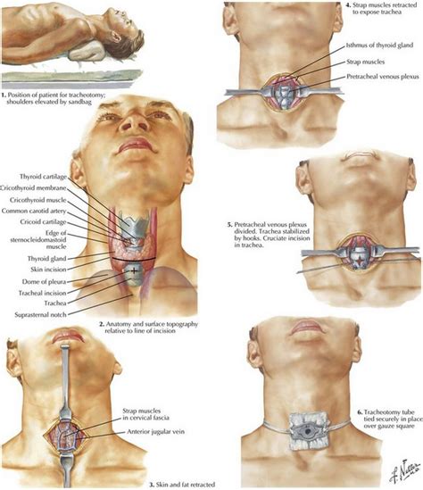 Tracheotomy and Cricothyrotomy | Basicmedical Key