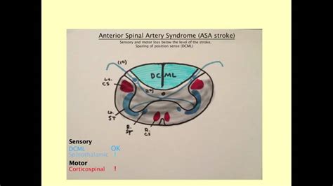 Anterior Spinal Artery Syndrome - CRASH! Medical Review Series - YouTube