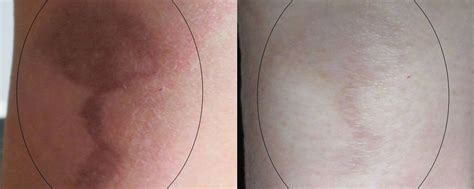 Burn Scar Laser Treatment - Connecticut Skin Institute