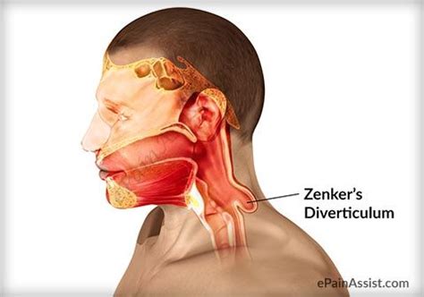 Zenker’s Diverticulum | Health, beauty, Medical, Aging process