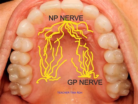 GREATER PALATINE INJECTION