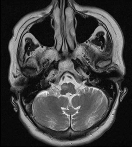 Midbrain Ct